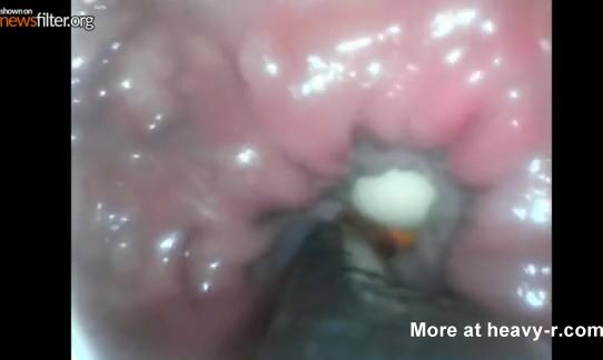 Disease From Anal Sex - Anal Sex Internal Camera View - HD Porn Videos, Sex Movies, Porn Tube